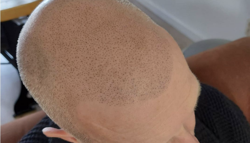 Micro haar pigmentatie hellevoetsluis